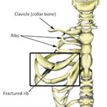 rib fracture symptoms
