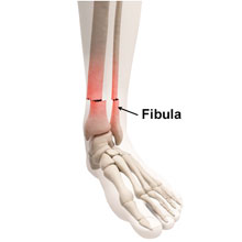fibula bone fracture