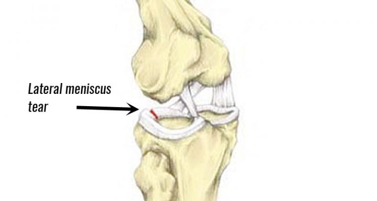 Knee Joint Pain Archives Sportsinjuryclinic Net