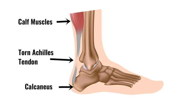 Achilles Tendon Rupture Treatment Rehabilitation Exercises