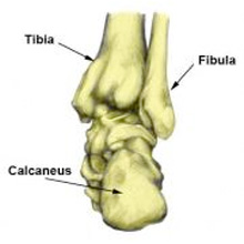 Calcaneal Stress Fracture - stress fracture of the heel bone ...