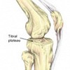 Articular Cartilage Injury | Symptoms & Treatment