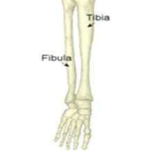 tibia stress fracture treatment