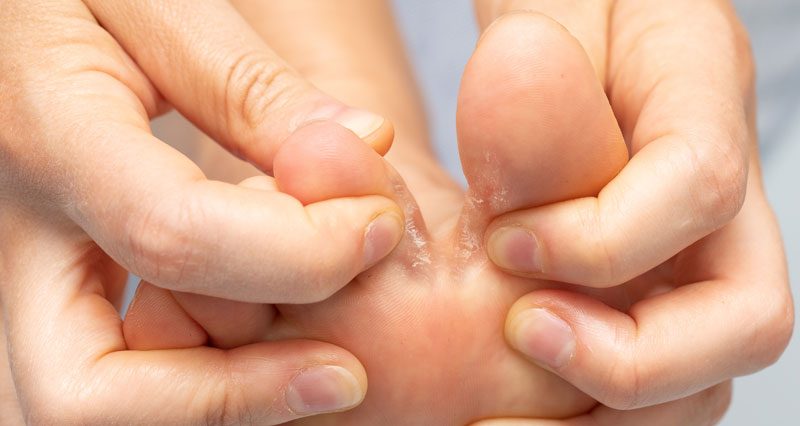 Athlete's Foot  Tinea Pedis - Symptoms, Causes, Treatment
