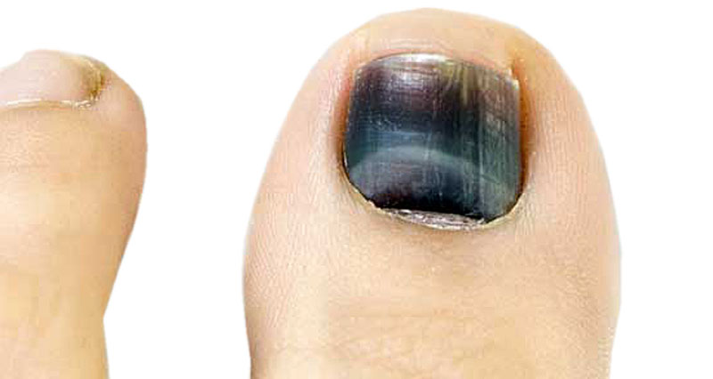 Toes of a Female Foot Close-up with Nails Affected by a Fungus on a Black  Background Stock Photo - Image of candida, body: 201928624