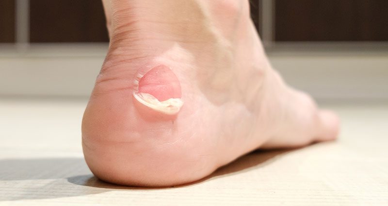 Blisters on Feet: Causes and Treatments