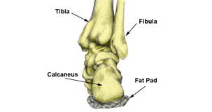 cracked heel bone