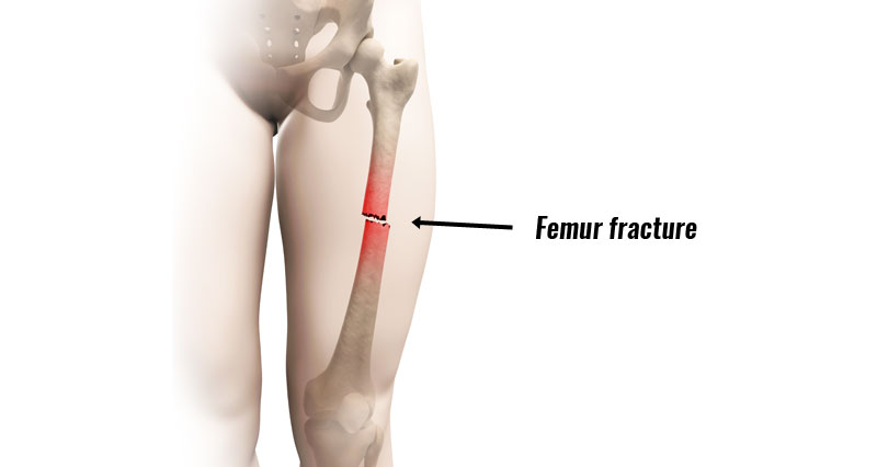 Femur Fracture Acute Broken Thigh Bone Causes And Treatment