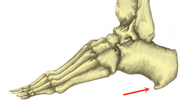 symptoms of bone spurs in feet
