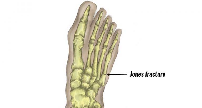 jones fracture foot