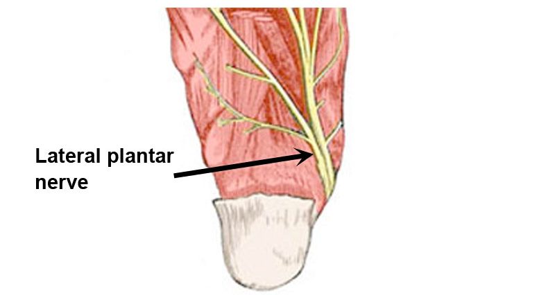 lateral heel pain after running