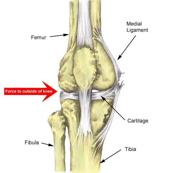 Medial Knee Ligament Mcl Sprain Symptoms Treatment