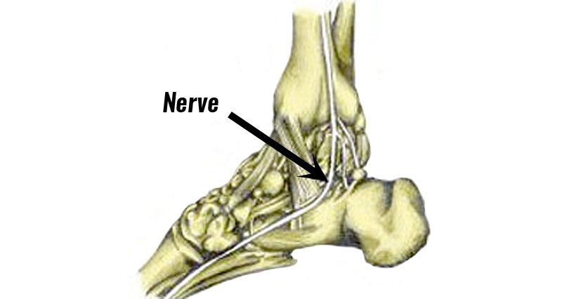 heel nerve entrapment