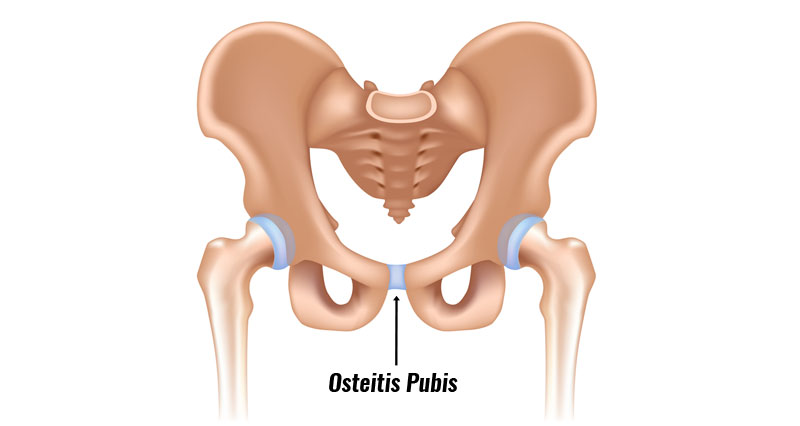 Osteitis Pubis - Symptoms, Causes, Treatment and Rehabilitation