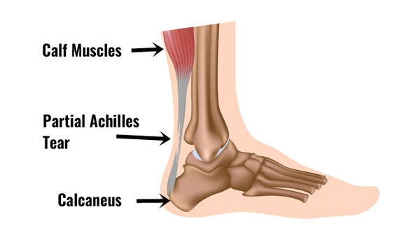 Achilles Tendon Tear - Footcare Friday: Alpine Orthopedics and Sports  Medicine: Orthopedic Surgery