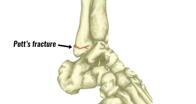 Ankle fracture: Types, signs and symptoms and treatment 