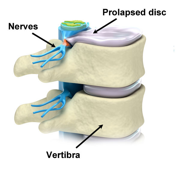 Protect Your Spine: What You Need to Know About Herniated Discs