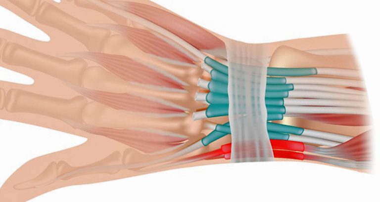 Wrist Tendonitis Symptoms Causes Treatment And Rehabilitation 8622