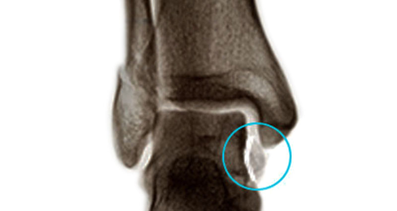 Ankle Avulsion Fracture - Symptoms, Causes & Treatment