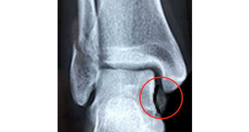 medial malleolus avulsion fracture