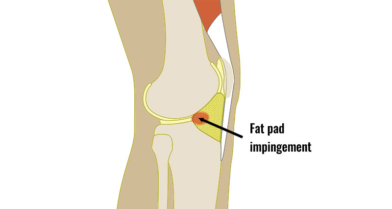 What Is Heel Fat Pad Syndrome? - Tower Foot & Ankle - Blog