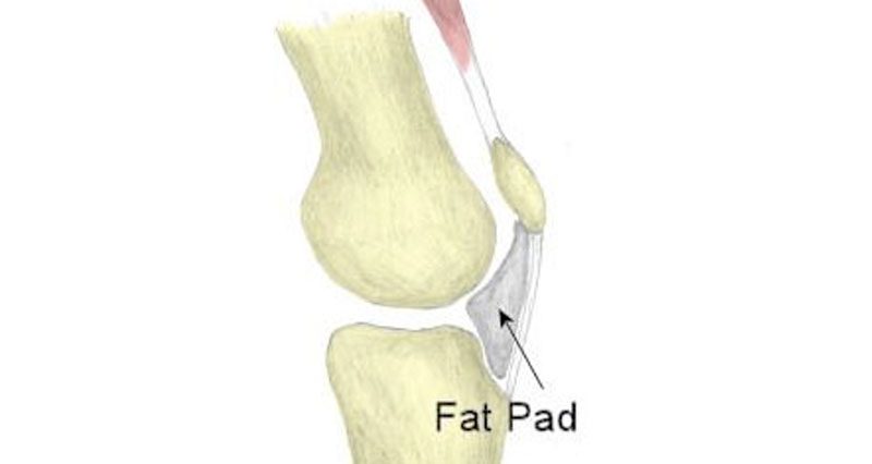 Knee Fat Pad Impingement - Symtpoms, Causes and Treatment