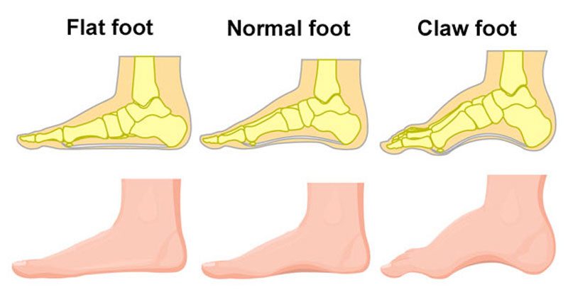 flat feet and normal feet