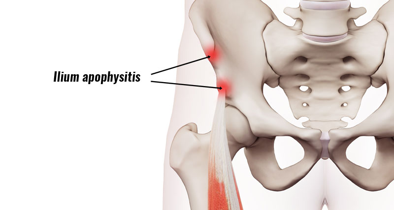 Ilium Apophysitis - Causes, Symptoms & Treatment.