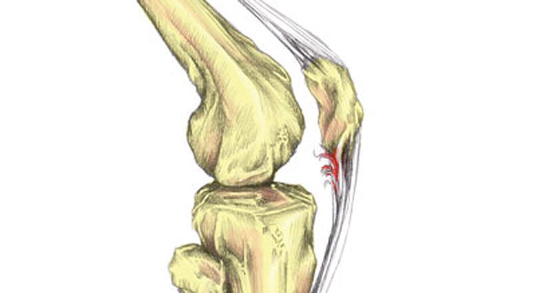 Why Do You Experience Patellar Tendon Pain?