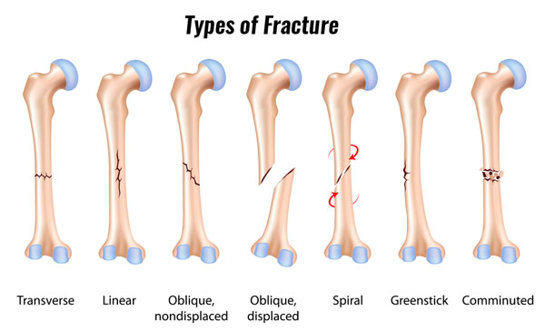 tibia bone fracture