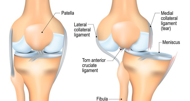 Dislocated Knee - Symptoms, Causes 