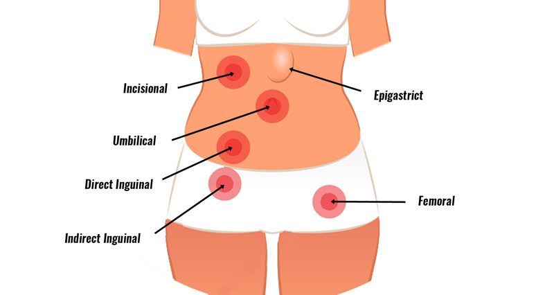 Hernia Explained: Symptoms, Types, Causes & Treatment