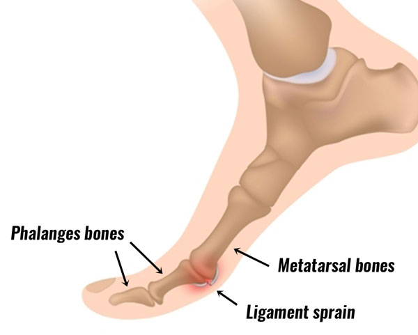 Turf Toe - Symptoms, Causes, Treatment 