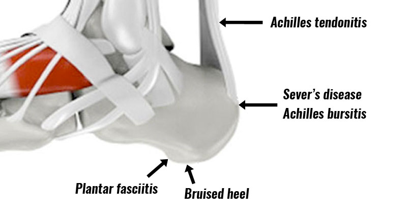 Standing for Long Periods of Time May Cause a Heel Spur