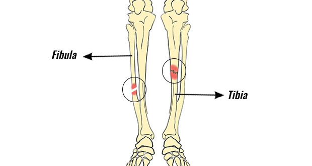 Lower Leg Fractures 