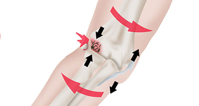 Osteochonritis dissecans elbow