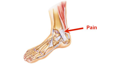 pain on the inner side of the heel