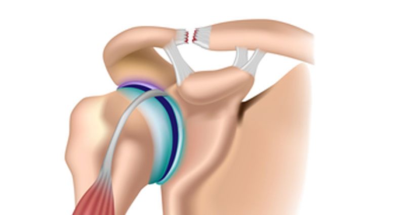 Acromioclavicular Joint - AC Joint in shoulder, AC Joint Pain
