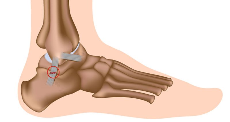 Sprained Ankle - Treatment, Rehabilitation & Exercises