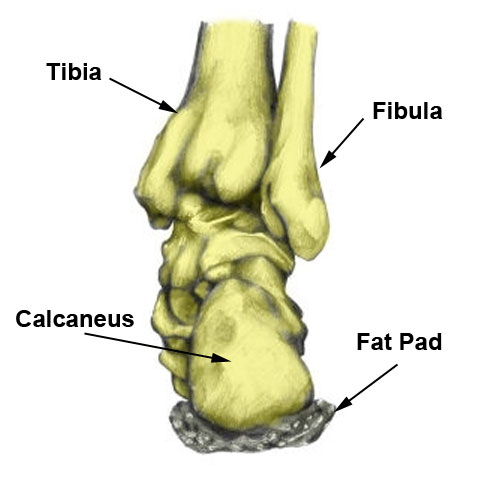 calcaneus fracture swelling