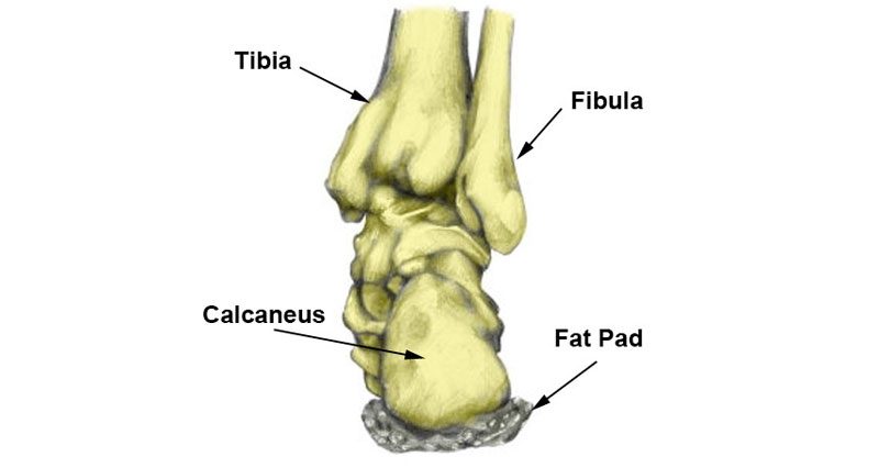 Bruised Heel - Symptoms, Causes 