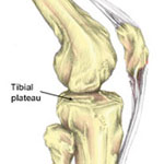 Dolor agudo de rodilla - Lesiones articulares de rodilla ...