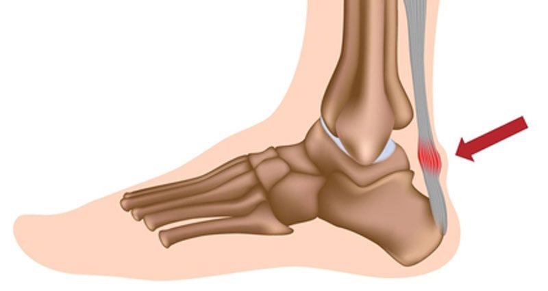 What Is Achilles Tendonitis and How Is It Treated? | The Podiatry Group of  South Texas