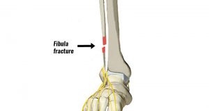 broken tibia and fibula surgery
