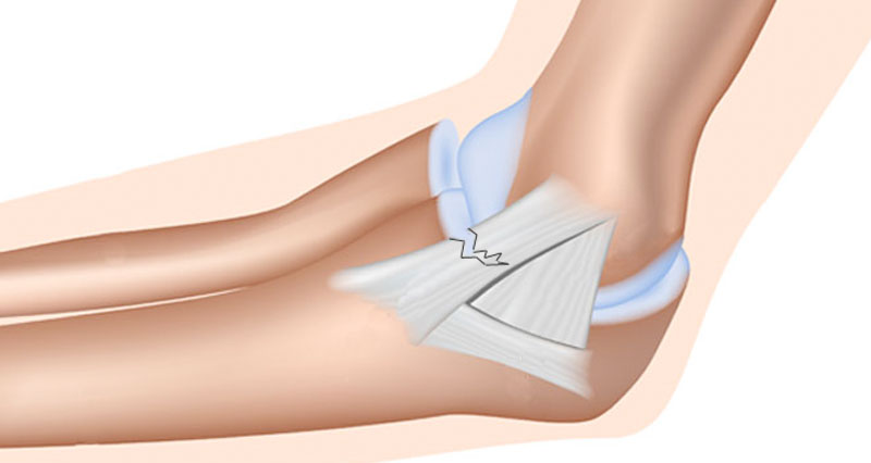 Medial collateral ligament injury elbow