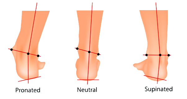 overpronation and supination of the foot