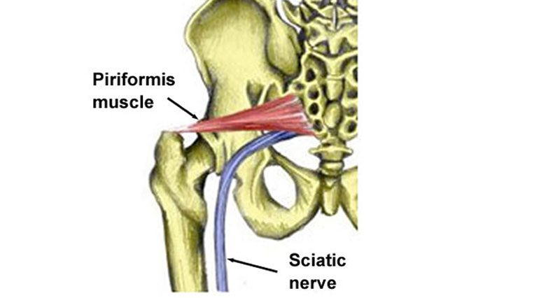 What is Piriformis Syndrome & How to Address Hip Pain? - Upswing