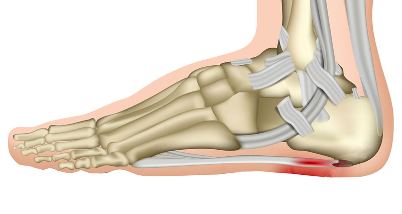 Heel Pain or Plantar Fasciitis - Great Northern Physical Therapy