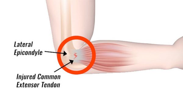 Tennis Elbow Symptoms Causes Treatment And Exercises