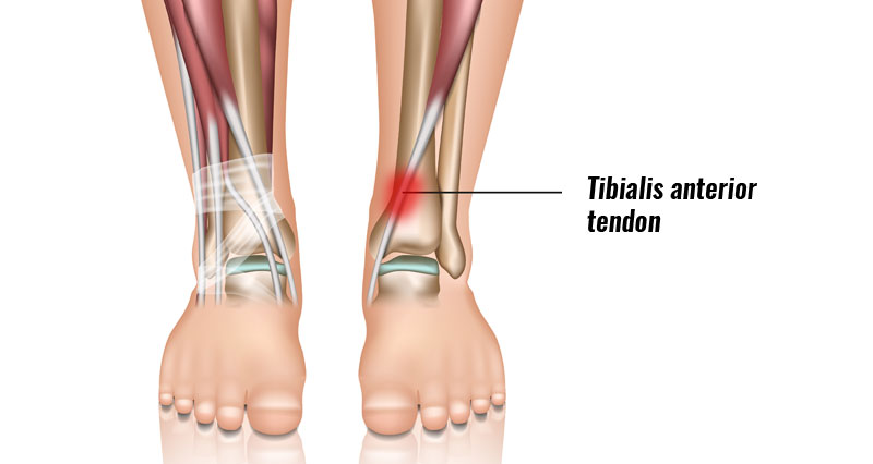 Best Shoes For Anterior Tibialis Tendonitis Encycloall